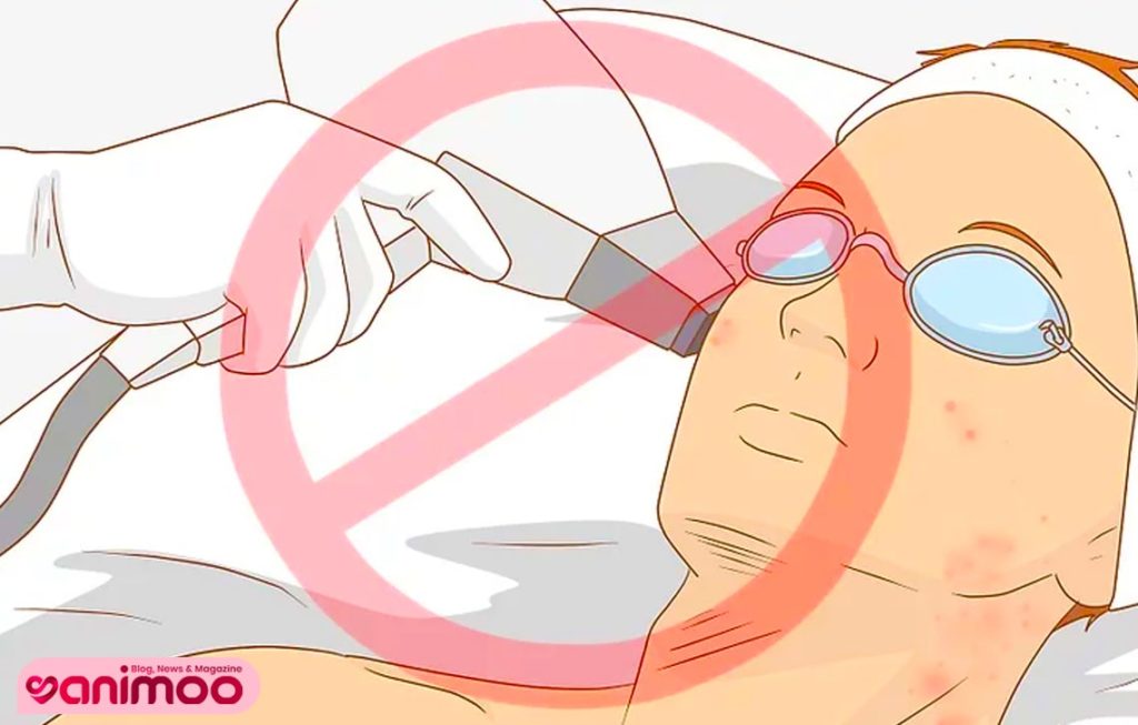 لایه برداری با لیزر را انجام ندهید - مراقبت پوستی قرص راکوتان